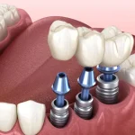 Embracing the Future of Dentistry: Customising Your Dental Implant Experience