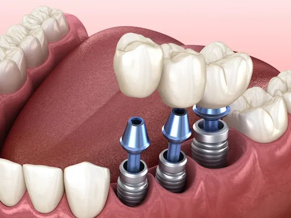 Embracing the Future of Dentistry: Customising Your Dental Implant Experience